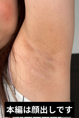 褐色に変色した腋の匂い嗅いでみる？みみの腋鑑賞
